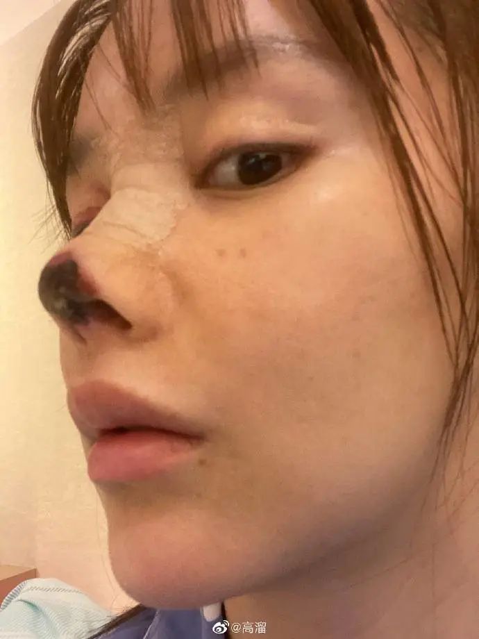 演员高溜整容失败鼻头坏死维权_整容失败的女明星中国_医美事故受害者高溜